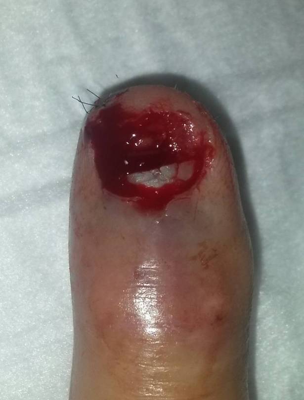 After_Surgery